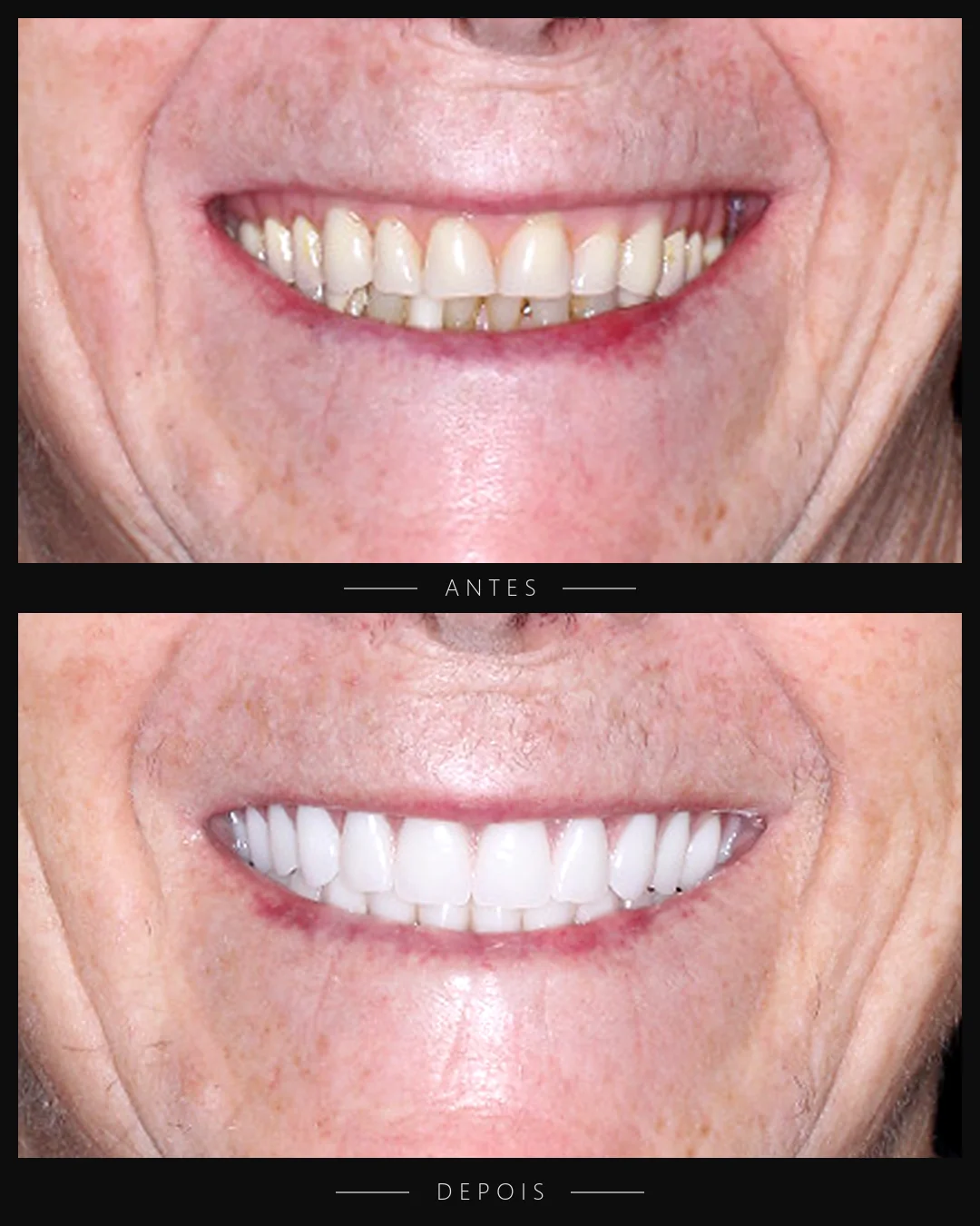 Antes e depois do sorriso de paciente da Resolut