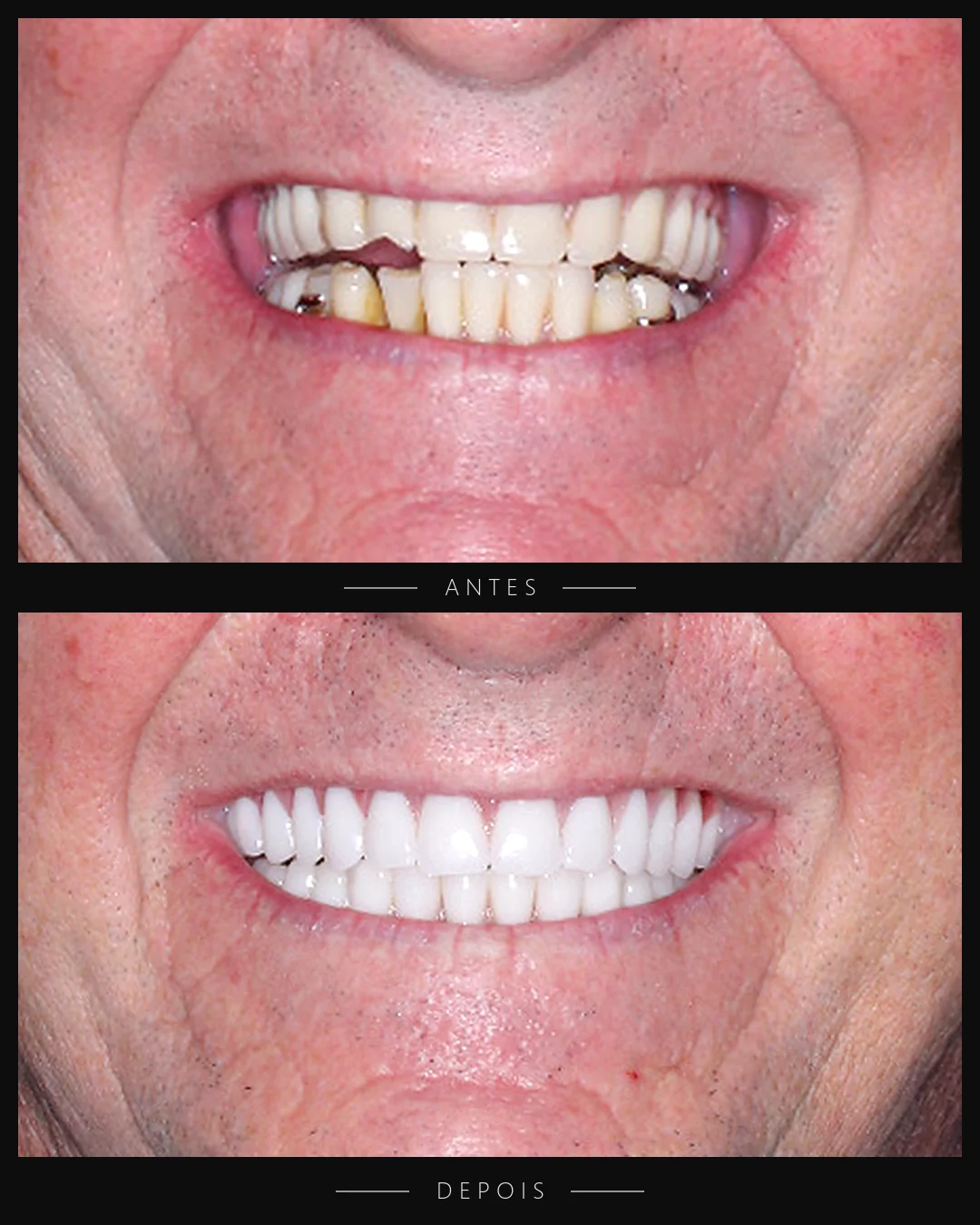 Antes e depois do sorriso de paciente da Resolut