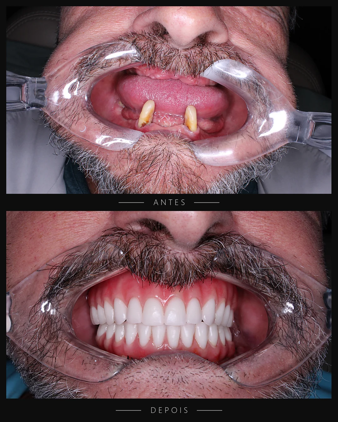 Antes e depois do sorriso de paciente da Resolut