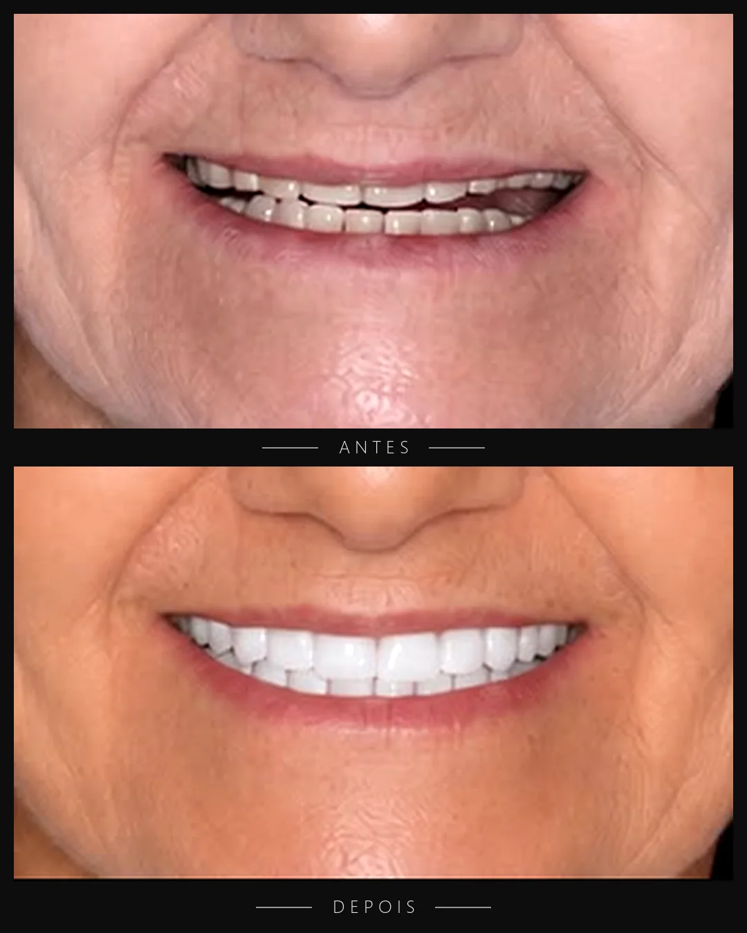 Antes e depois do sorriso de paciente da Resolut