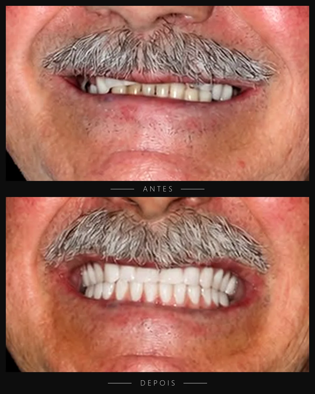 Antes e depois do sorriso de paciente da Resolut