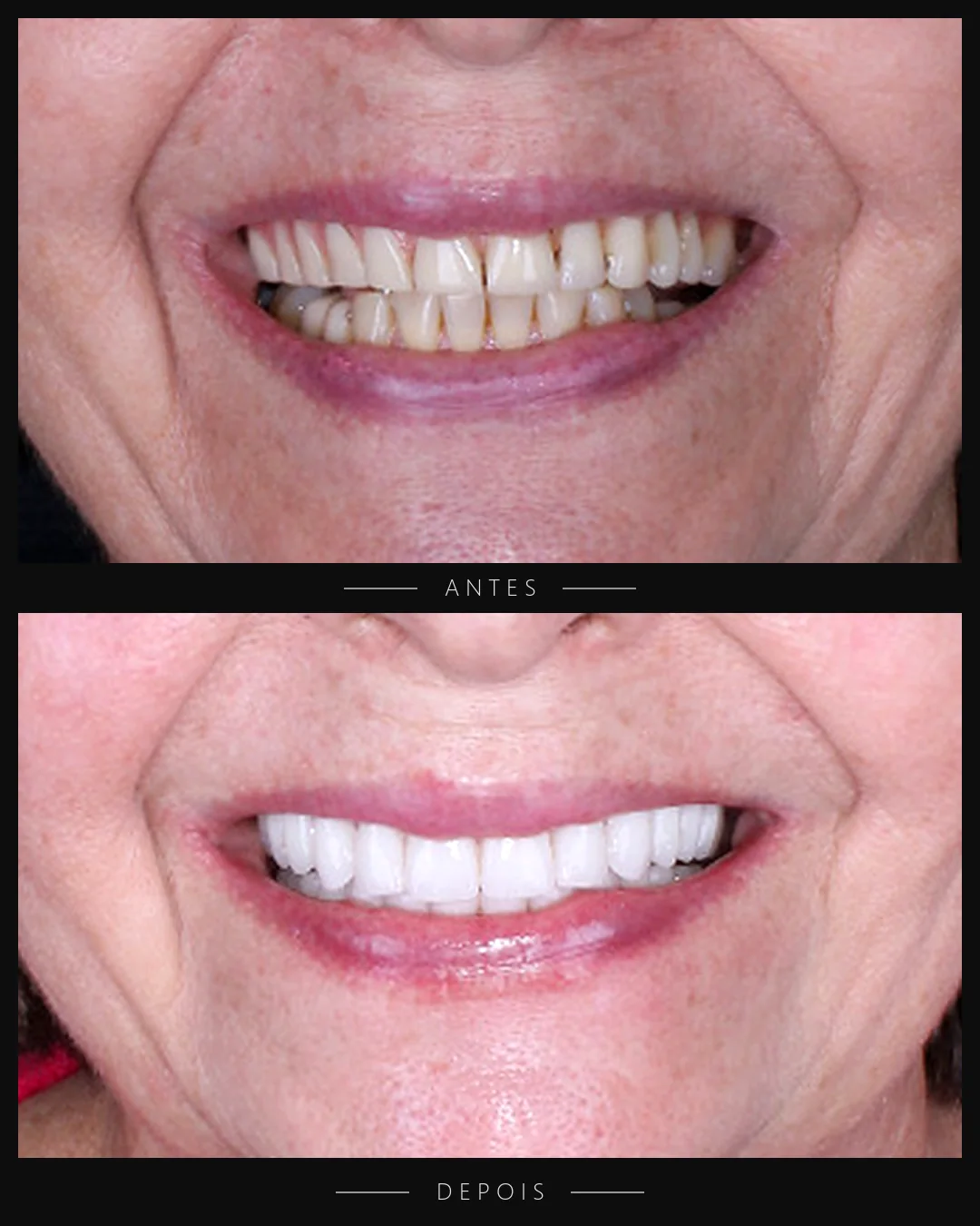 Antes e depois do sorriso de paciente da Resolut