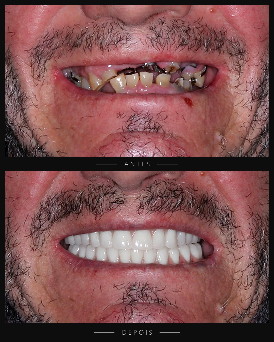 Antes e depois do sorriso de paciente da Resolut