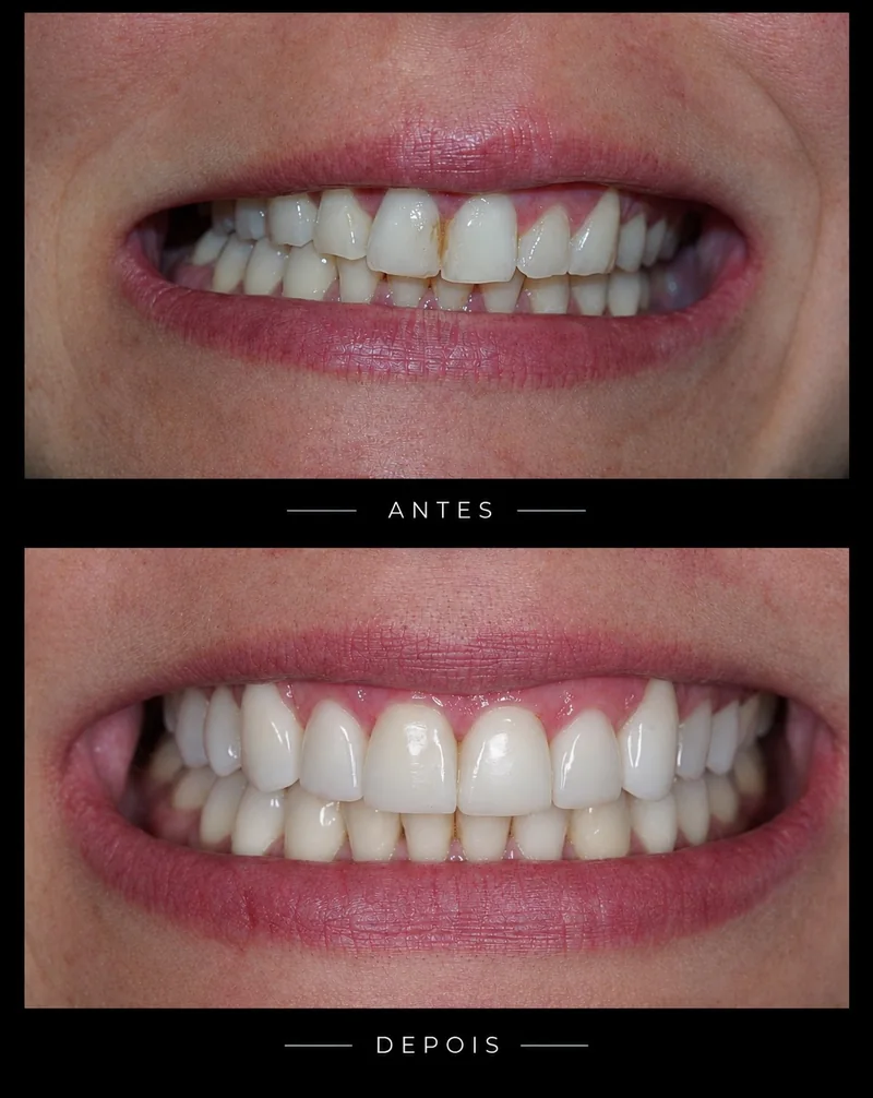 Antes e depois: sorriso renovado, dentes mais claros e alinhados