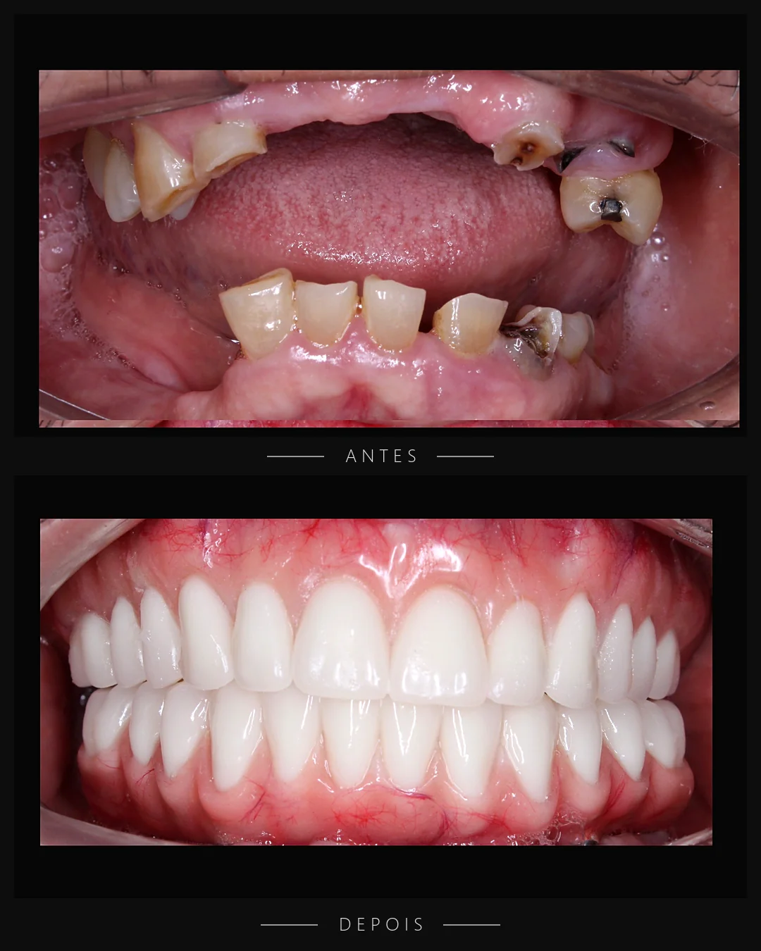 Antes e depois do sorriso de paciente da Resolut