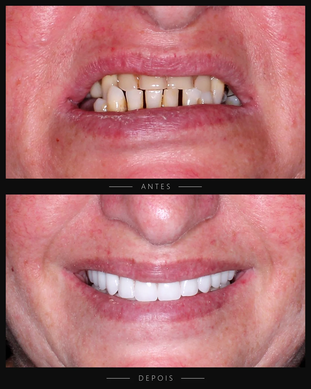 Antes e depois do sorriso de paciente da Resolut
