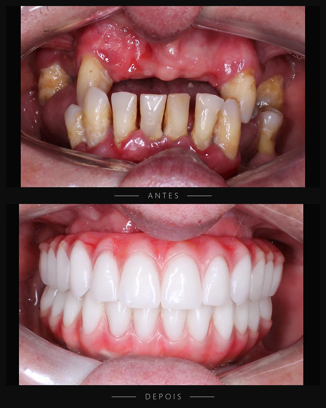 Antes e depois do sorriso de paciente da Resolut