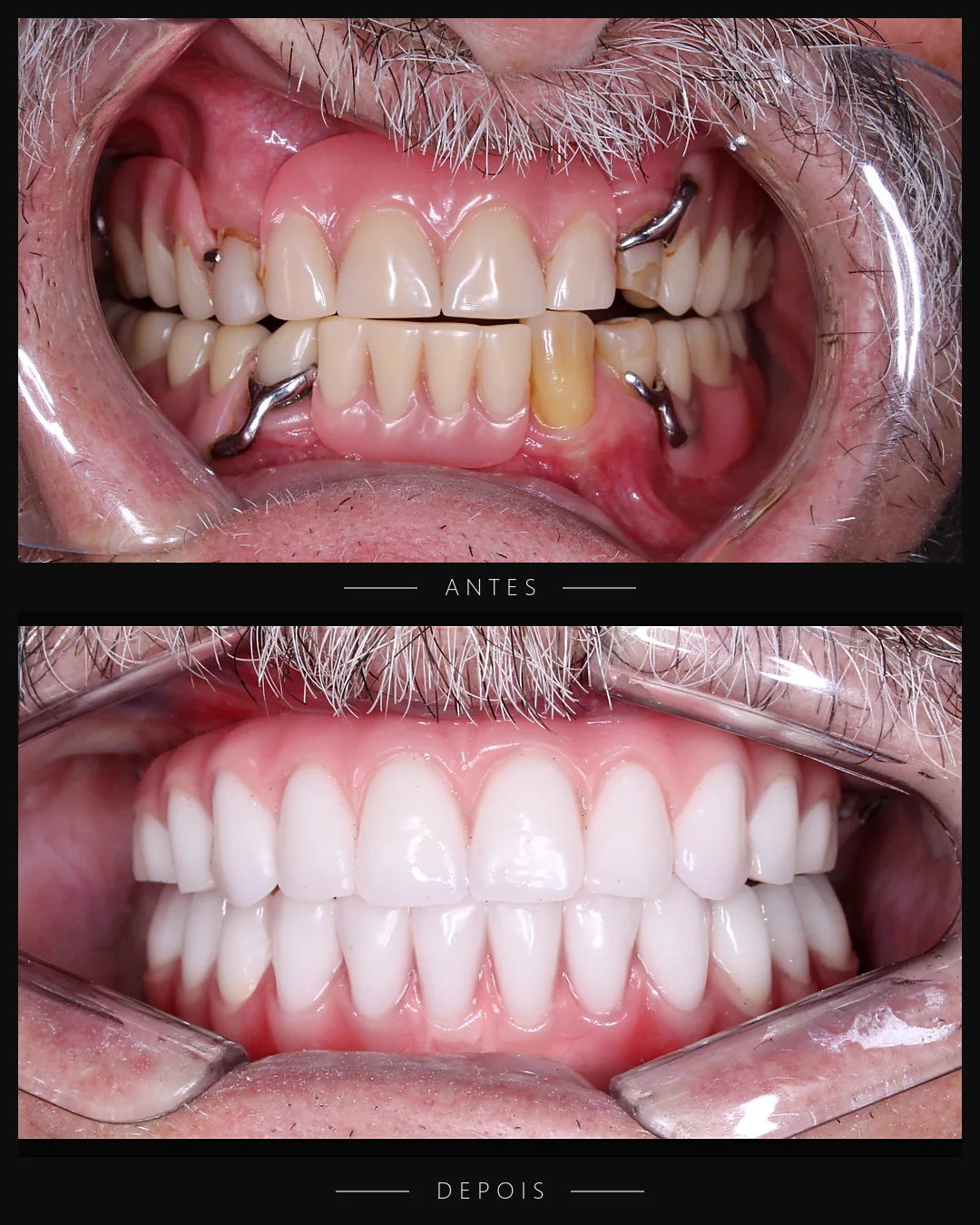 Antes e depois do sorriso de paciente da Resolut