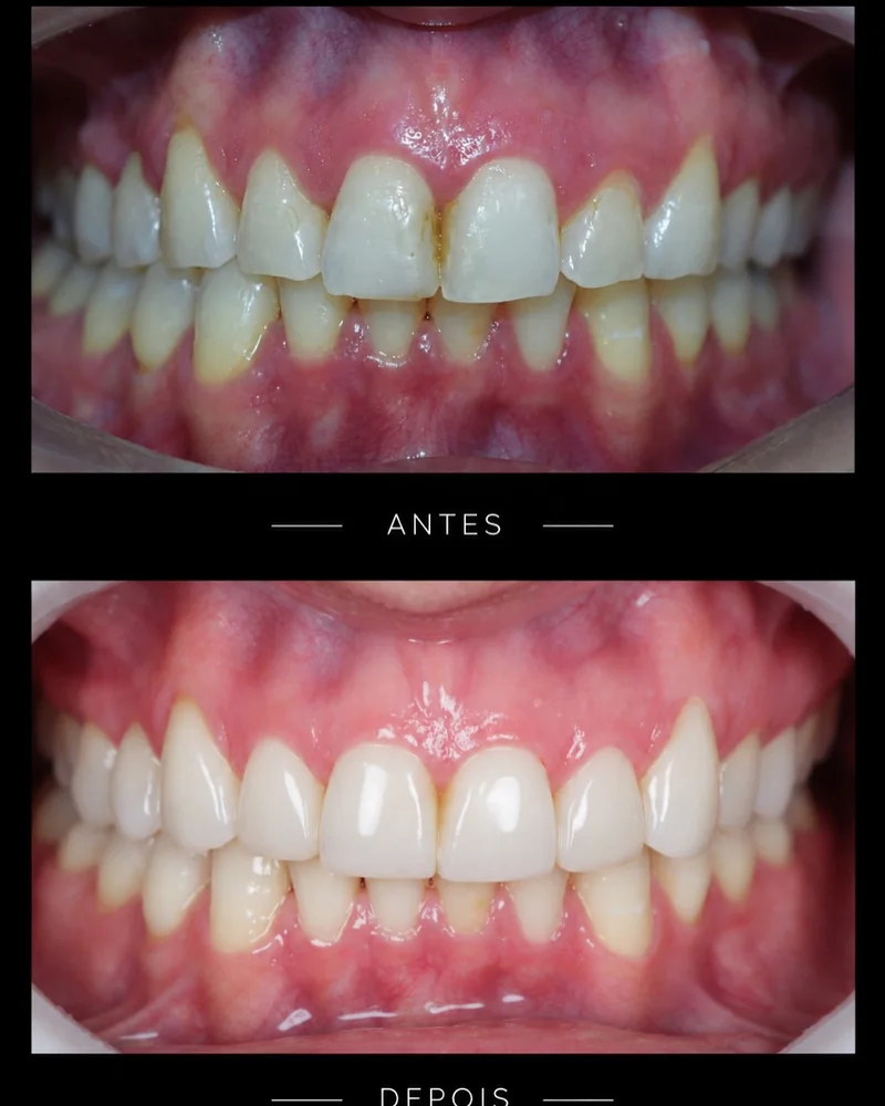 Antes e depois: dentes da frente refeitos, forma e cor uniformes
